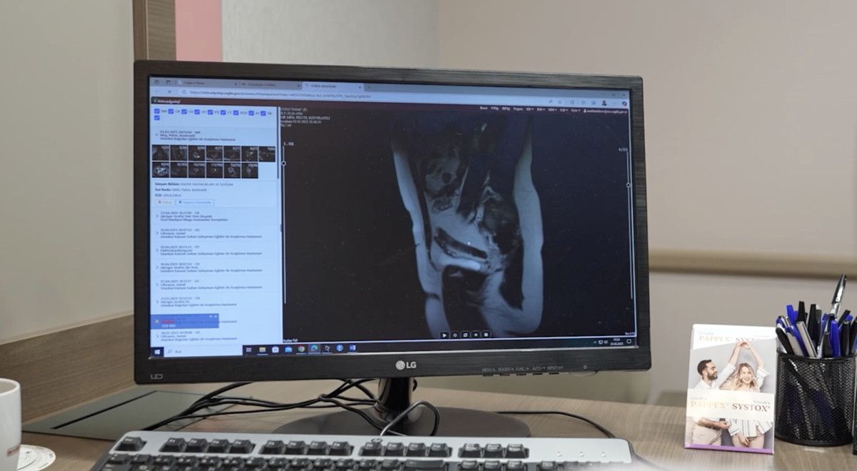 Endometriozis: Çikolata Kisti ve Kısırlık Üzerindeki Etkileri Gözden Geçiriliyor